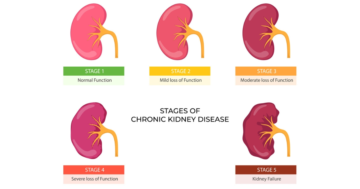 Stages of Chronic Kidney Disease